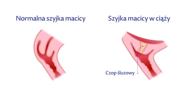 Czy krótka szyjka macicy ułatwia poród? Fakty, zagrożenia i porady dla kobiet w ciąży Czy krótka szyjka macicy ułatwia poród? Fakty, zagrożenia i porady dla kobiet w ciąży