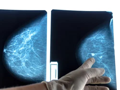 Objawy guza piersi – jak rozpoznać niepokojące zmiany i kiedy iść do lekarza Objawy guza piersi – jak rozpoznać niepokojące zmiany i kiedy iść do lekarza